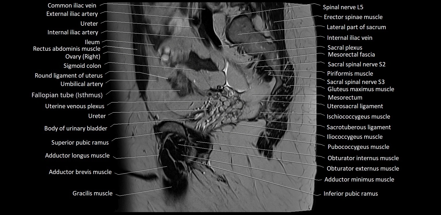 Sagittal cross sectional anatomy of female pelvis (MRI 3T) image 13.webp